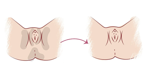 Vulval Peels
